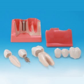 Maxi Implantat/Bro Studiemodel 